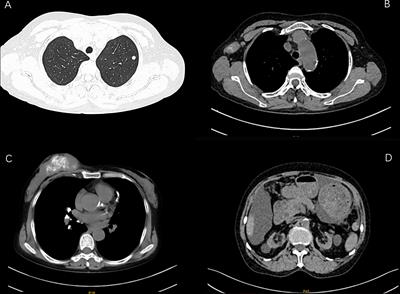 Durable effect of pyrotinib plus capecitabine in HER-2+ breast cancer patient undergoing peritoneal dialysis: A case report and literature review